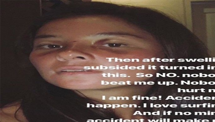 Andi mukhang nabugbog ang hitsura