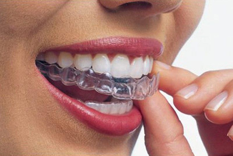 The experience of wearing invisible braces