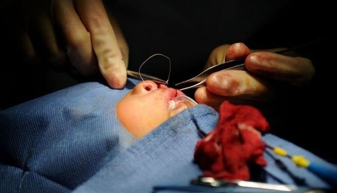 Foreign doctors perform charity surgeries in Philippines