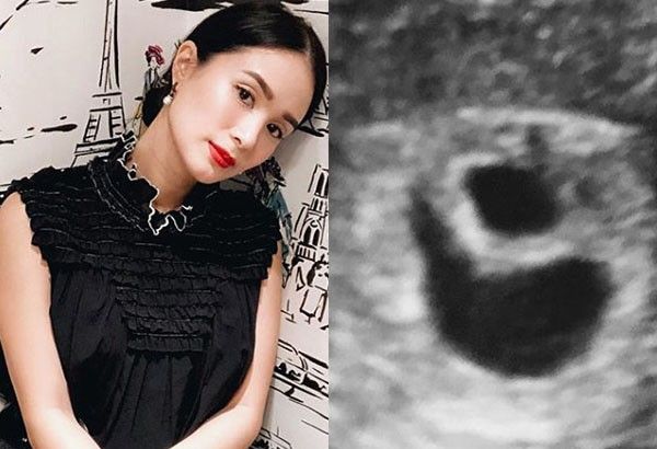 How Heart Evangelista turned an accident into a very expensive