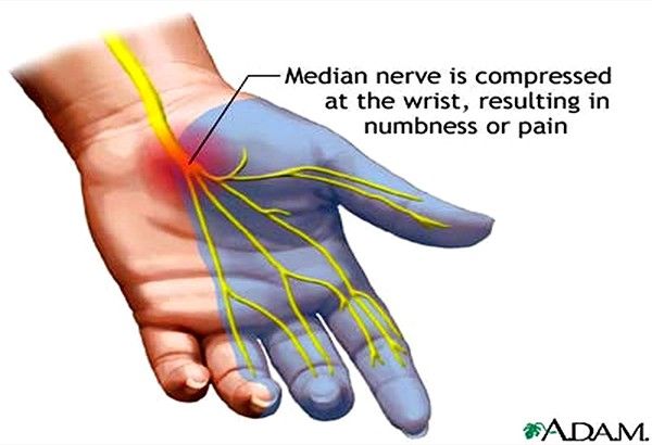 Numb hands and fingers: Itâs carpal tunnel syndrome
