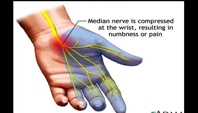 Numb hands and fingers: It&rsquo;s carpal tunnel syndrome
