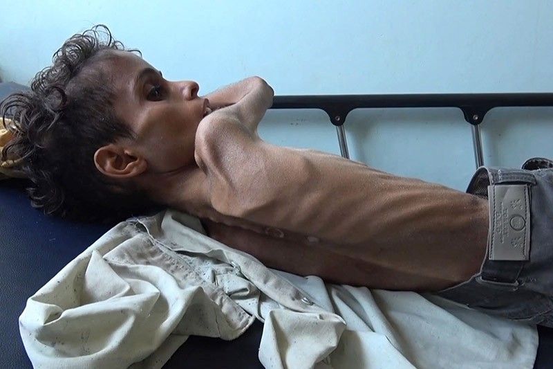 Starvation leaves Yemeni boy Ghazi too weak to cry
