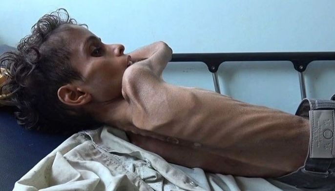 Starvation leaves Yemeni boy Ghazi too weak to cry