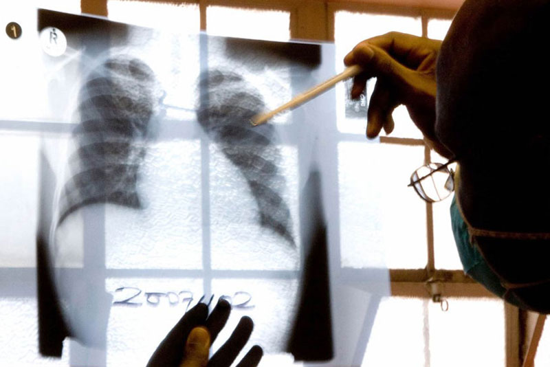 Western Pacific asked to provide access to tuberculosis treatment