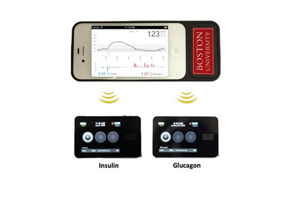 Progress made on a 'bionic pancreas' for diabetics