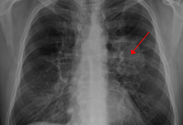FDA approves Genentech drug for advanced lung cancer