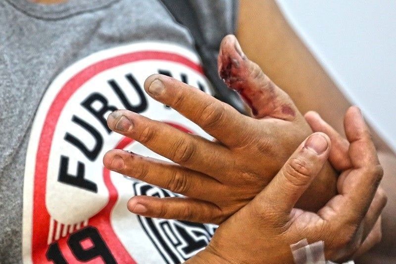 Firecracker injuries up in Central Visayas
