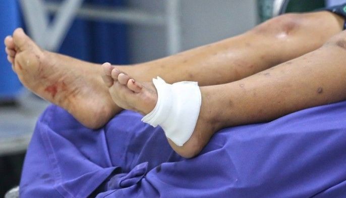 Firecracker injuries nadagdagan ng 98