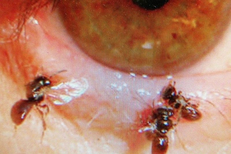 Sweat bees found living inside woman's eye