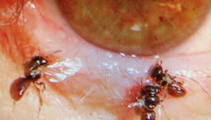 Sweat bees found living inside woman's eye