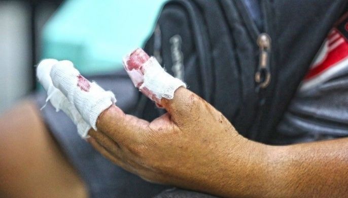DOH: 3 more hurt in firecracker blasts