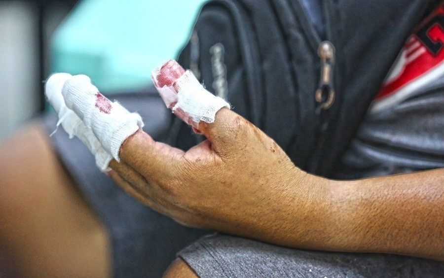 9 more firecracker injuries recorded