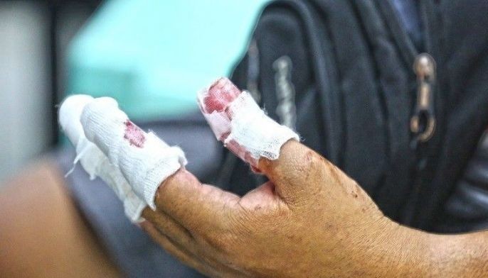 9 more firecracker injuries recorded