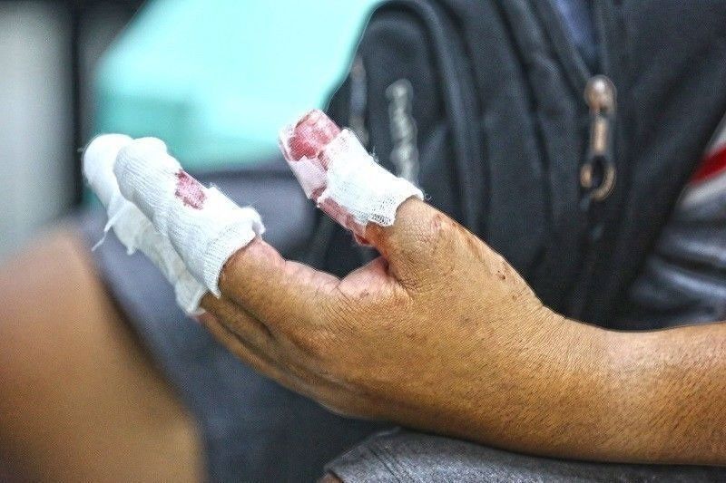 Ecija boy loses fingers; âcracker injuries hit 54