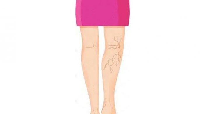 Varicose veins can be fatal