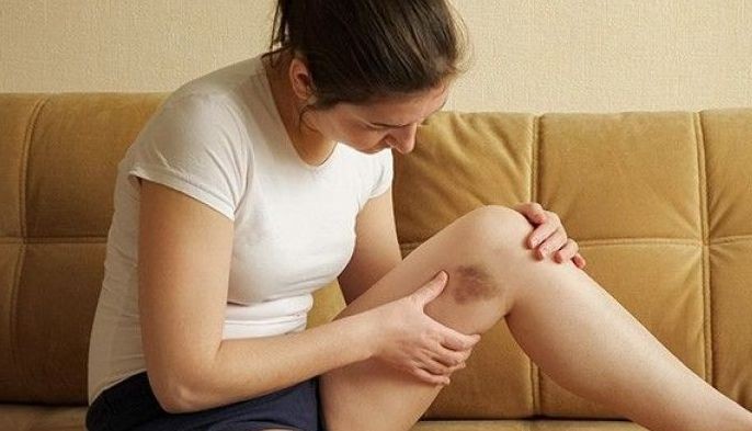 LIST: Doctor sheds light to causes of bruises, rashes