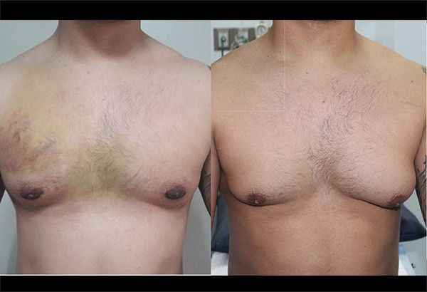 Male breast reduction: Surgeon explains link between 'man boobs' and mental  health