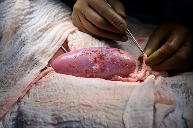 Pig kidney works in human patient in 'potential miracle'