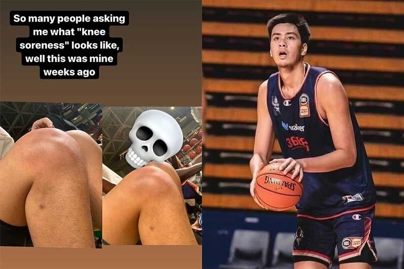 Kai Sotto menunjukkan cedera lutut yang paling parah