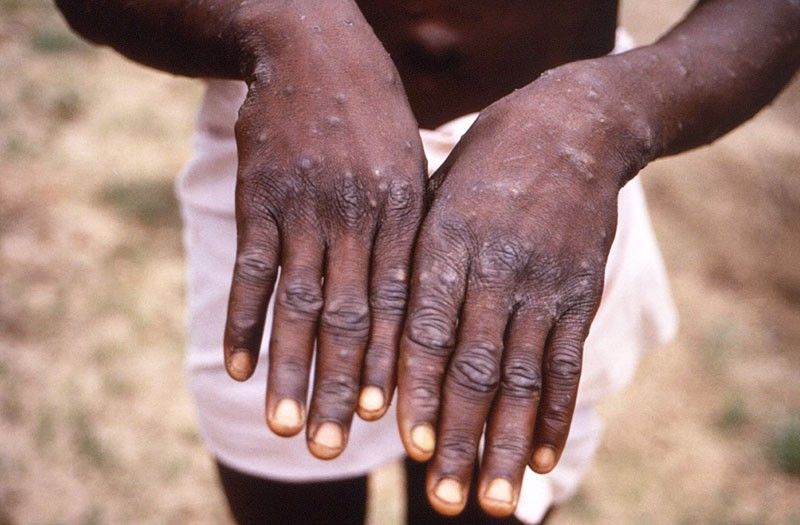 Europe 'epicenter' of monkeypox outbreak â WHO