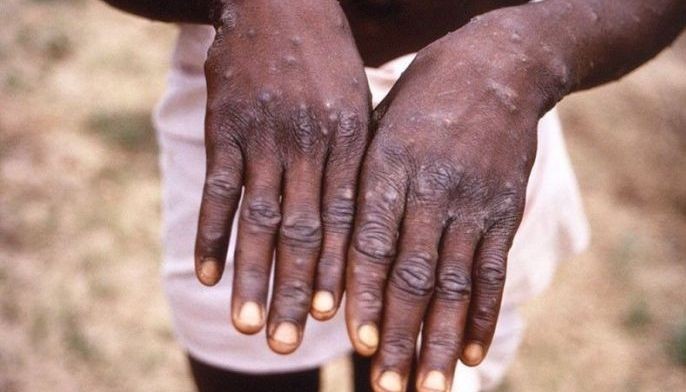 Monkeypox virus kaya nang matukoy ng RITM