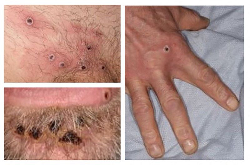UK monkeypox symptoms different to prior outbreaks â study