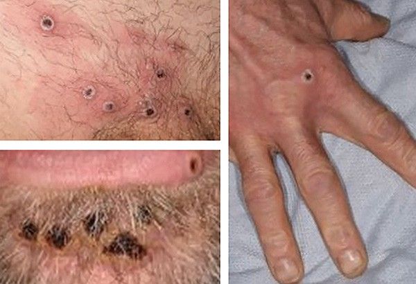 Monkeypox: Symptoms, diagnosis, treatments, vaccines