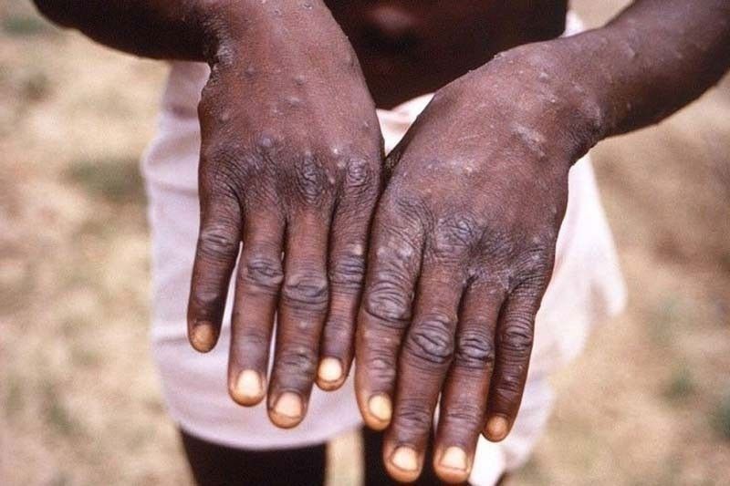 Monkeypox papalitan ng pangalan