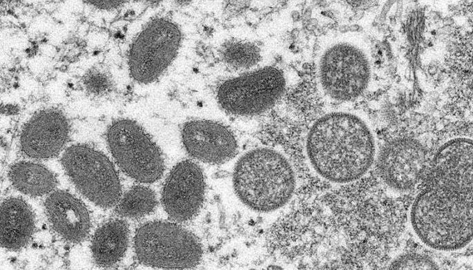 2 kaso pa ng monkeypox sa Pinas, natukoy