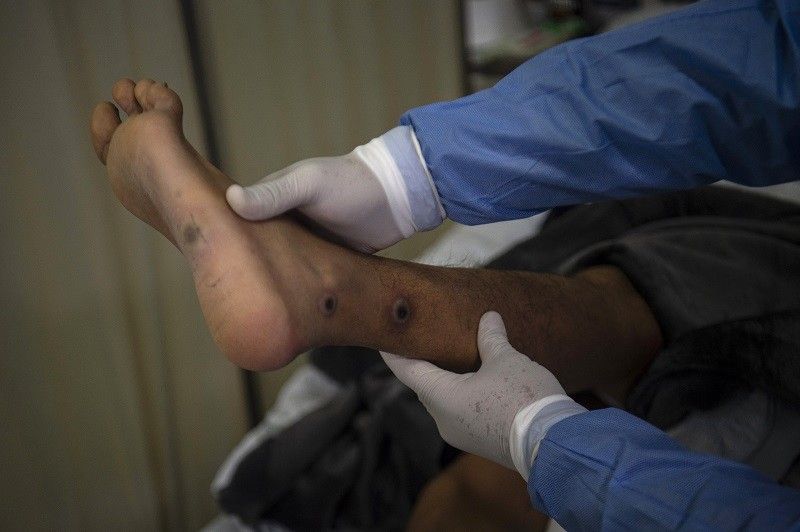 Ika-4 na monkeypox case nakita sa 25-anyos na Pinoy na 'walang travel history'