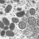 DOH: Too soon to say if there has been local transmission of monkeypox
