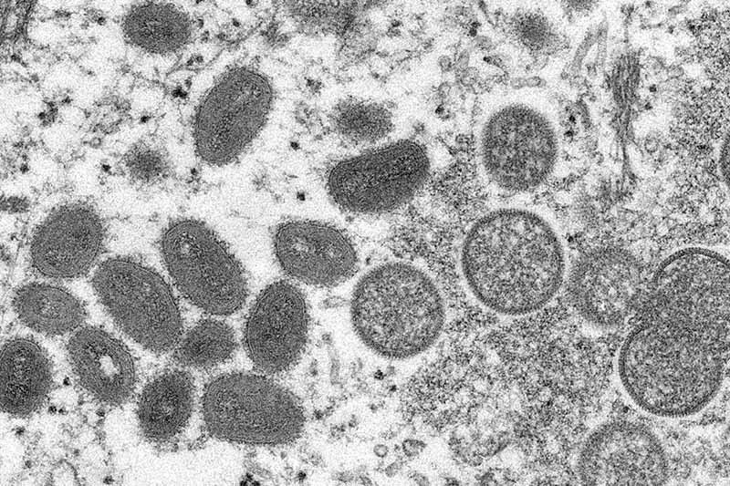 Second US monkeypox death as virus linked to brain inflammation