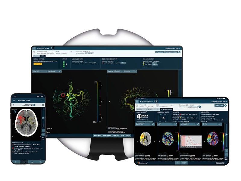 AI-powered technology sees big improvements in UK stroke treatment â�� analysis