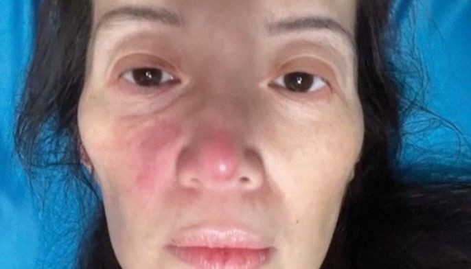 Mukha at katawan tadtad ng pasa at pantal... Kris, 'di pa rin nauumpisahan ang pagpapagamot sa Amerika! | Pang-Masa
