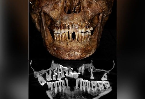 French aristocrat's golden dental secret revealed 400 years on