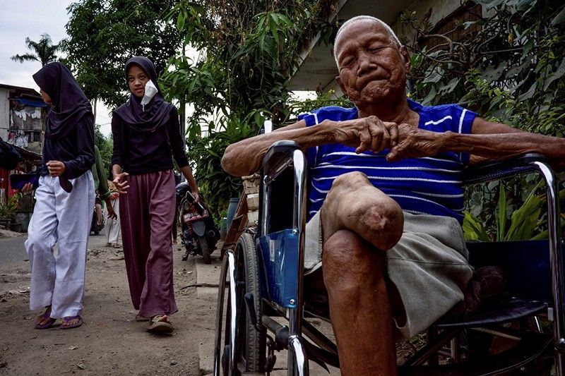 'Constant danger': Life after leprosy, a long neglected disease