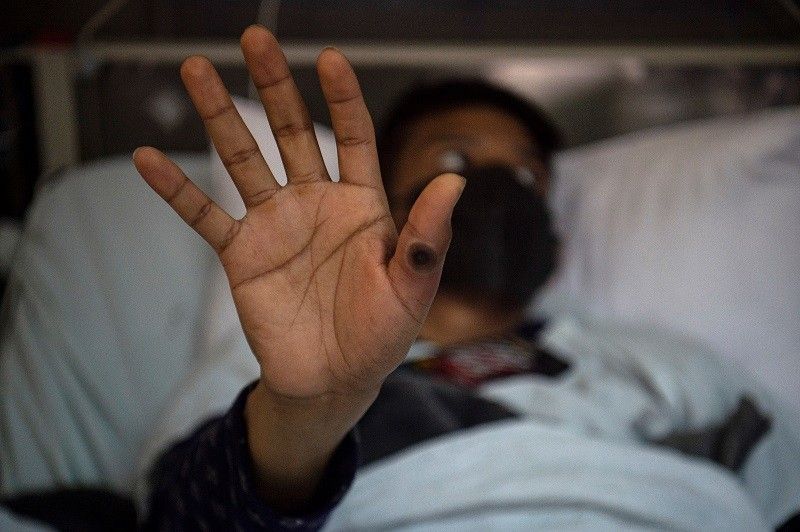 'Road to recovery': DOH welcomes lifting of global health emergency vs monkeypox