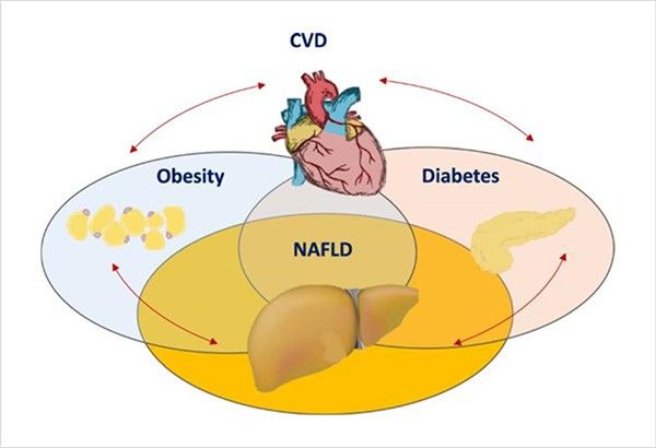 Deadlier type of Fatty Liver Disease increasing in the Philippines â doctors