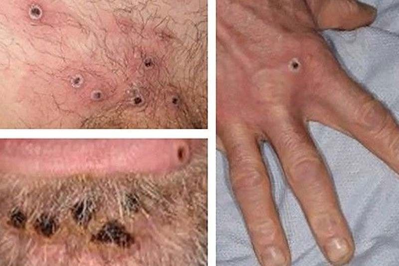 DOH denies monkeypox fatality in Negros Oriental