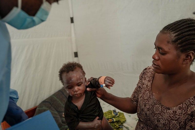 Mpox cases rise in DR Congo as country awaits vaccines