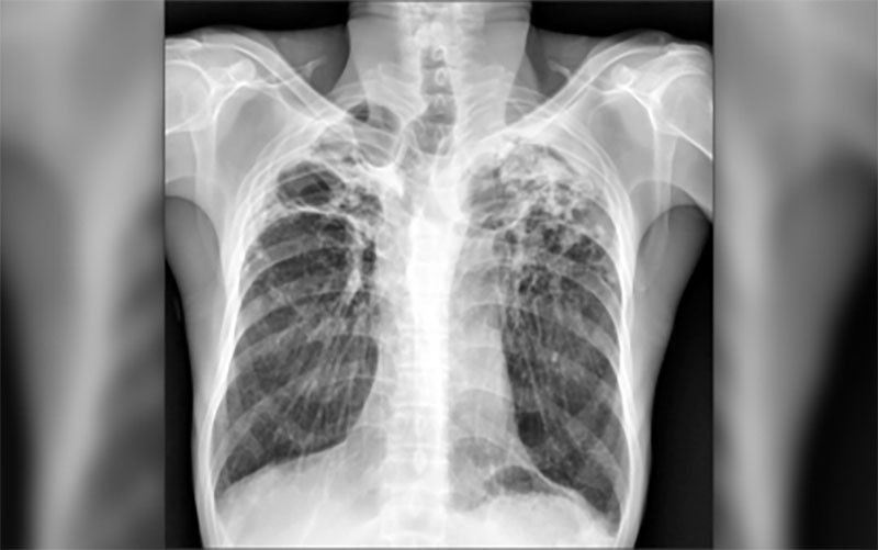 ‘Milk not a cure for TB’