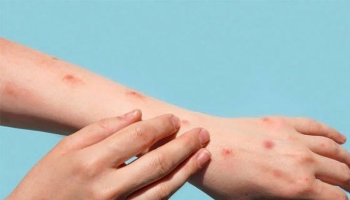 Mpox pasok na rin sa Aurora, 1 kaso naitala