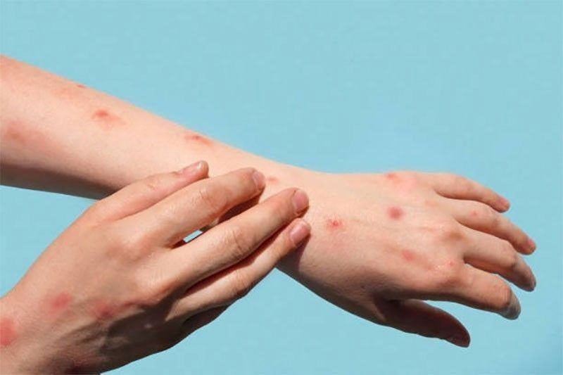 First mpox case confirmed in Bacolod
