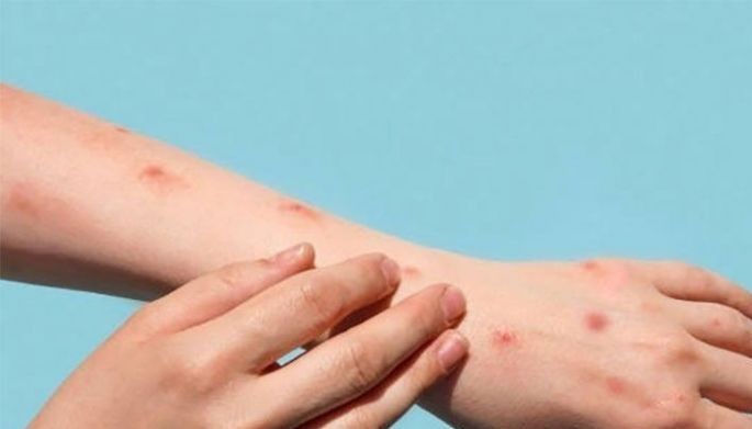 First mpox case confirmed in Bacolod