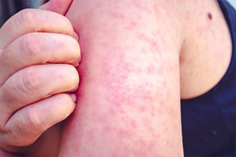4,718 measles, rubella cases logged nationwide