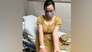 Dahil sa stress...Yasmien, nagdurusa sa urticaria